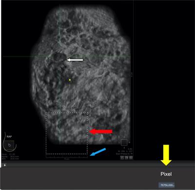 Evaluation of a new method of calculating breast tumor volume based on automated breast ultrasound